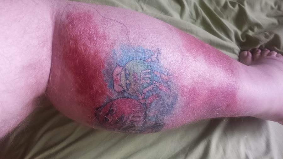 tattoo roodheid en zwelling